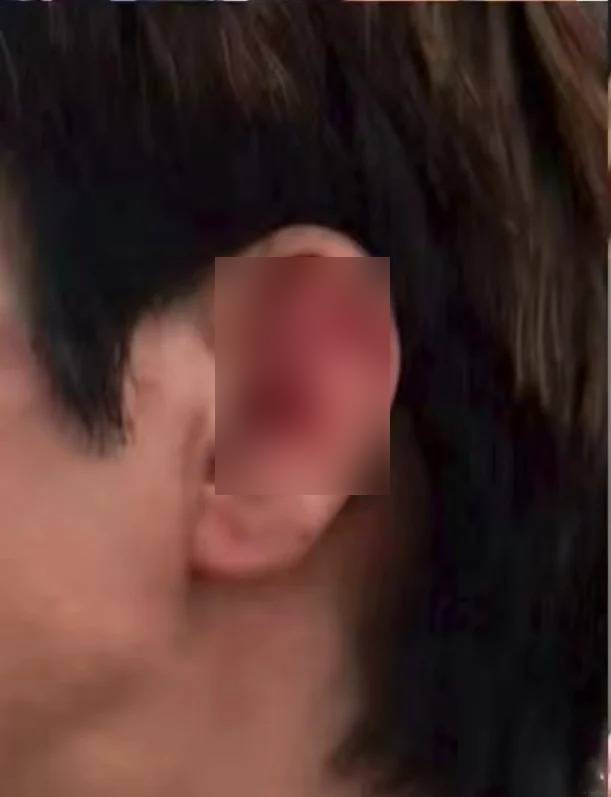 王力宏被“威吔”绊倒致左耳及脸部共缝39针。小红书 王力宏被“威吔”绊倒致左耳及脸部共缝39针。小红书